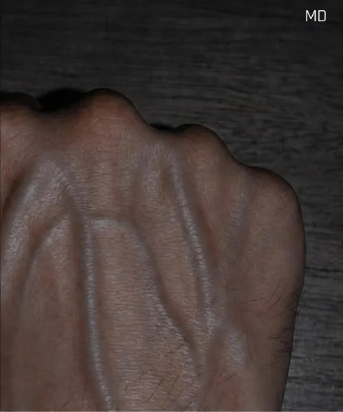 Why Veins May Appear More Noticeable at Certain Times